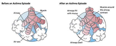 Asthma